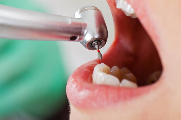 Best Emergency Tooth Extraction in Atlanta, TX